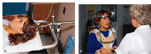 Methods of cervical skeletal traction. (A) Crutchfield tongs. (B) Halo device. 
