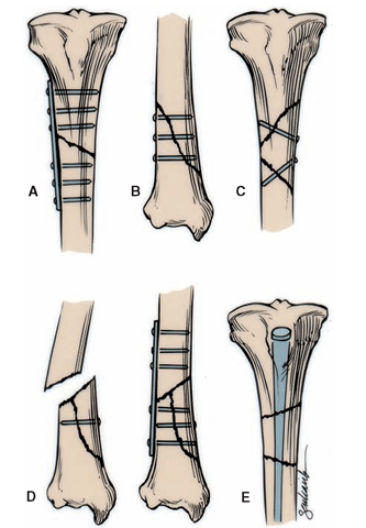 Types of internal fixation. (A) Plate and screws secure a transverse fracture. (B) Screws secure a long oblique fracture. (C) Screws secure a long butterfly fragment of bone. (D) Plates and screws secure a short butterfly fragment. (E) A medullary nail secures a segmental fracture of the femur 