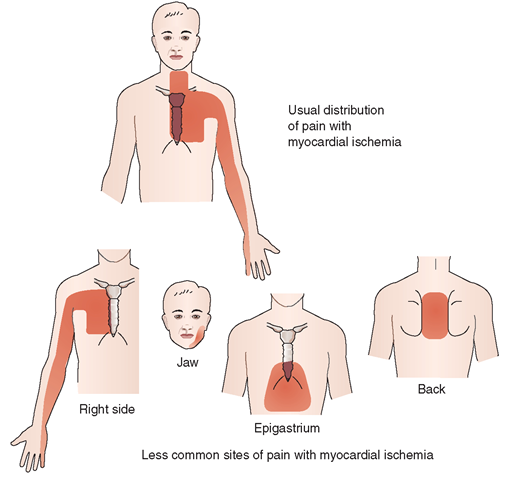 Pain patterns with myocardial ischemia. The usual distribution of pain is referral to all or part of the sternal region, the left side of the chest, the neck, and down the ulnar side of the left forearm and hand. With severe ischemic pain, the right side of the chest and right arm are often involved as well, although isolated involvement of these areas is rare. Other sites sometimes involved, either alone or together with pain in other sites, are the jaw, epigastrium, and back. 