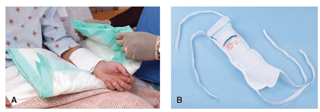  Cold applications are often used to reduce pain and swelling or to arrest bleeding. (A) The cold compress is a moist cold application (Timby, 2005). (B) An ice pack or ice bag filled with crushed ice is a dry cold application.