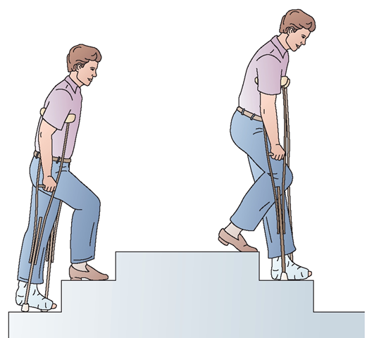  Stair climbing with crutches can be difficult. Balance must be maintained to prevent falls. Step “up with the good”; step "down with the bad.” 