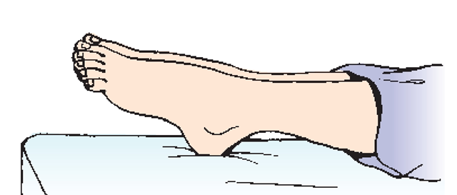 Abnormal plantar flexion, if not corrected, may lead to a deformity called footdrop. 