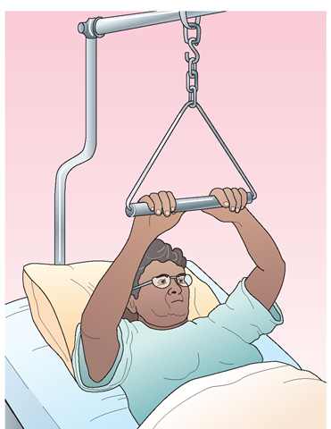 An overbed frame with a trapeze allows the client to lift the upper body off the bed and to move about in bed. It can also be used for bed exercises. 