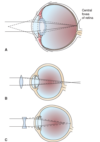 (A) Accommodation. The solid lines represent rays of light from a distant object, and the dotted lines represent rays from a near object. The lens is flatter for the former, and more convex for the latter;In each case, the rays of light are brought to a focus on the retina.(B)    Hyperopia corrected by a biconvex lens, as shown by the dotted lines.(C)    Myopia corrected by a biconcave lens, as shown by the dotted lines. In each of these illustrations, the goal is to focus the light rays exactly at the central fovea.