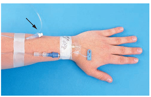 An intermittent infusion device (saline lock, intravenous [IV] port). This lock allows an IV to be restarted or small amounts of medication to be given with a syringe, without an additional venipuncture. The arrow points to the IV port on the extension tubing. This port is used to connect an IV tubing for continuous administration or to administer medications with a syringe. Note the blue slide clamp positioned above the client's hand; this is used to shut off flow in the lock. The notations on the tape indicate the date the lock was placed and the initials of the nurse.