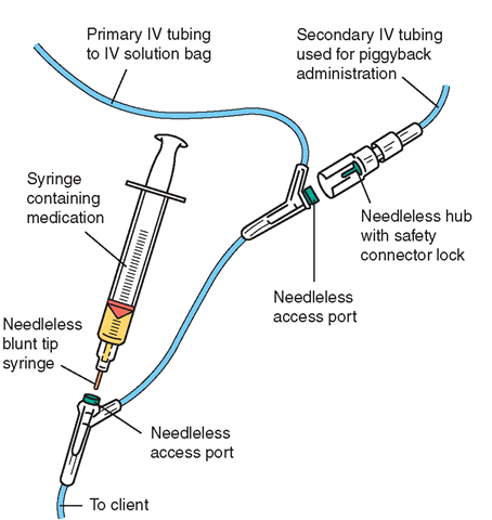 A basic intravenous (IV) setup includes tubing to deliver basic IV fluids via the client's venous access. Also shown are the access port on the tubing, used for injection of small amounts of medication by syringe (below) and the access port used for piggyback administration of larger amounts of medication (above). These needleless ports prevent needlestick injuries to staff. (Blood and total parenteral nutrition [TPN] are administered through a different type of IV tubing.