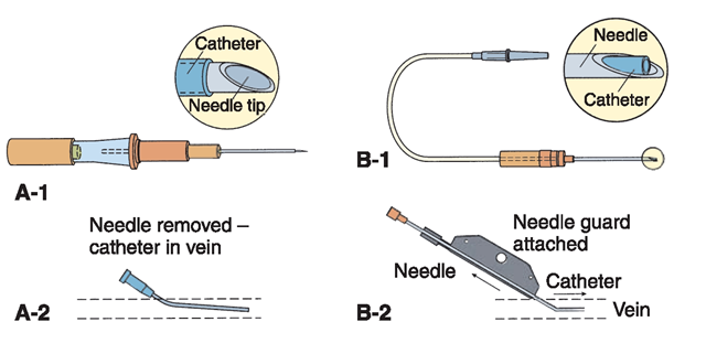 Venous access devices (VAD). In addition to the butterfly needle, two types of intracatheters are commonly used, allowing fluid to flow through a flexible catheter into the vein. (A-1) An over-the-needle catheter is inserted into the vein and, (A-2) the needle is removed, leaving the catheter in the vein.(B-1) A through-the-needle catheter is passed through the needle after the needle is inserted into the vein. (B-2) The needle is pulled out, leaving the catheter in the vein. Both of these devices today have a locking guard mechanism that locks the needle guard in place, to prevent needle sticks when the catheter is in place and when it is removed.