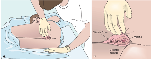 The side-lying position for female catheterization. Shown here is the position for the left-handed nurse. (A) The client is positioned on her side. After the client is positioned, the nurse must put on sterile gloves (because these gloves were contaminated during positioning). (B) The urinary (urethral) meatus is exposed and the catheter inserted.