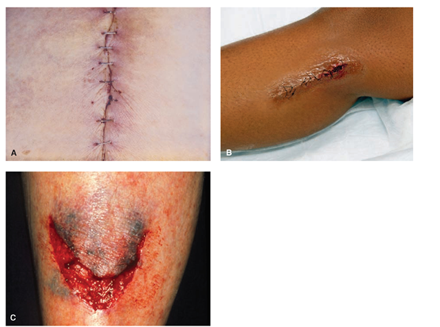 Types of wounds. (A) A surgical incision is an intentional wound. Here, the edges are brought together and stapled. (B) A surgical incision closed with sutures (stitches).(C) An unintentional wound, shown here, results from trauma. Open unintentional wounds have a high risk of infection.