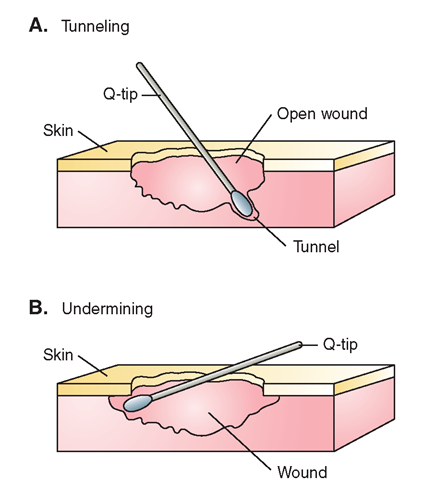 (A) Tunneling is measured by inserting a sterile cotton-tipped applicator into the tunnel and measuring the distance of insertion. Each tunnel is measured and documented separately. (B) Undermining is also measured using an applicator Usually. the undermining extends around the entire circumference of the wound, although the extent of the undermining may vary.