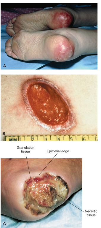 Stages of pressure ulcers (see also Box 58-1). Stage I (reversible) includes pressure-related changes in intact skin, when compared with adjacent skin (not shown). Some pressure ulcers are not stageable. The pressure ulcers shown here are (A) Stage II: partial-thickness tissue loss. No sloughing; may appear as blister: (B) Stage III: full-thickness tissue loss, with subcutaneous damage and drainage. May show tunneling or undermining. (Note procedure for measuring size of ulcer.) (C) Stage IV: full-thickness tissue loss, extensive destruction of muscle, bone, or other structures. Note undermining shown on upper edge of wound. 