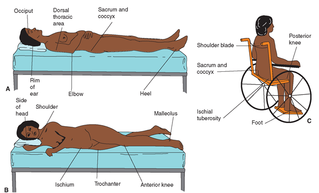 Common sites for pressure ulcers. (A) Supine position. (B) Side-lying position. (C) Sitting. Included also are sites of tube insertion (e.g., IV, NG tube, catheter, drains) 
