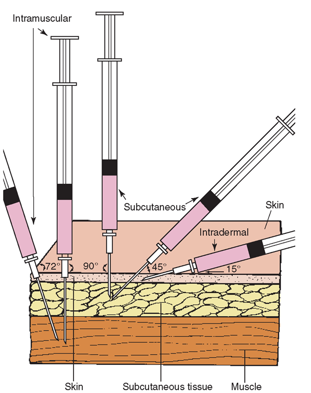 Comparison of the angles of insertion for intramuscular (IM), subcutaneous, and intradermal injections. An IM injection is given at a 72- to 90-degree angle. A subcutaneous injection is usually given at a 45-degree angle, but may be given at up to a 90-degree angle, if a short needle is used or if the person is heavy. The intradermal injection is given holding the syringe nearly parallel to the skin (10- to 15-degree angle).