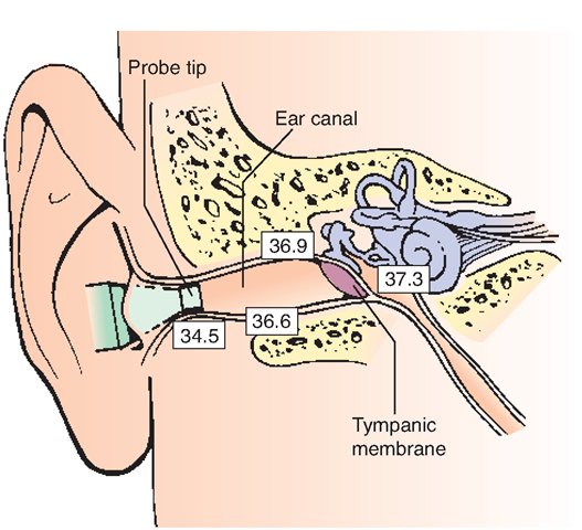 Obtain the most accurate tympanic temperature by aiming the probe toward the anterior inferior third of the ear canal (toward the jaw line). (Readings here are shown in Celsius.) 