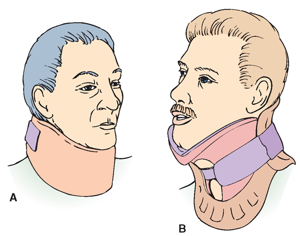 (A) A foam cervical collar. (B) A rigid cervical collar; Untrained personnel should not attempt to apply a cervical collar, except in an extreme emergency. 